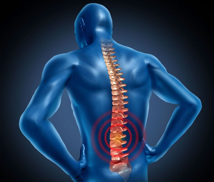 Bedrová osteochondróza