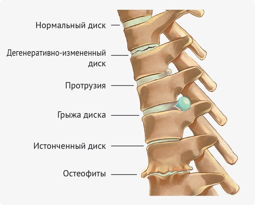 Deformácie disku pre bedrovú osteochondrózu