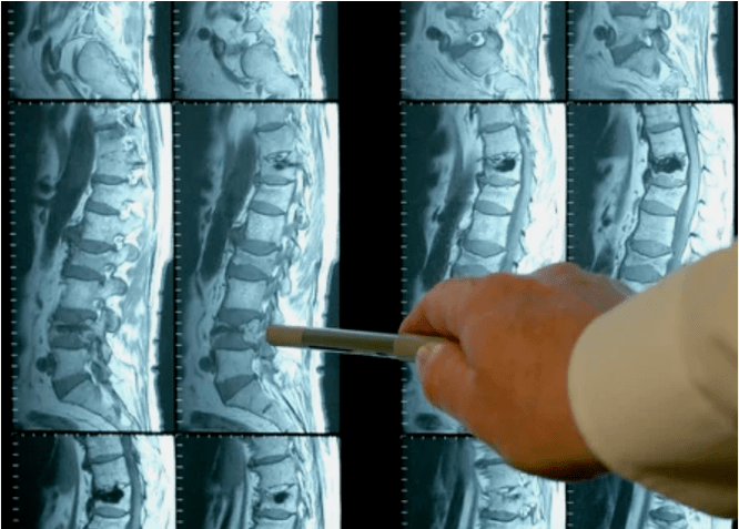 Odrody osteochondrózy v chrbtici