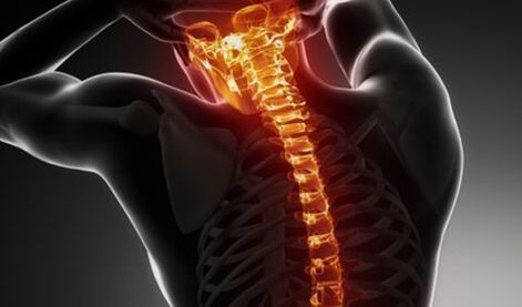 Osteochondróza celej chrbtice