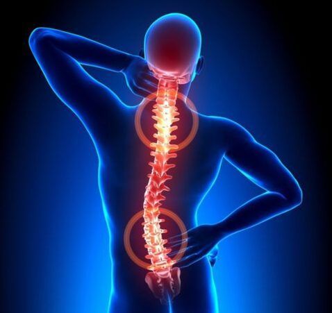 Osteochondróza chrbtice