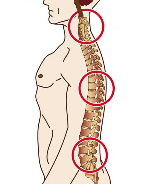 miechové oddelenia, v ktorých dochádza k osteochondróze