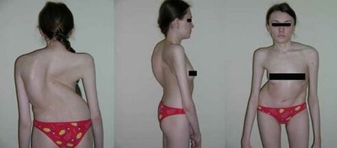 zakrivenie chrbtice v dôsledku osteochondrózy