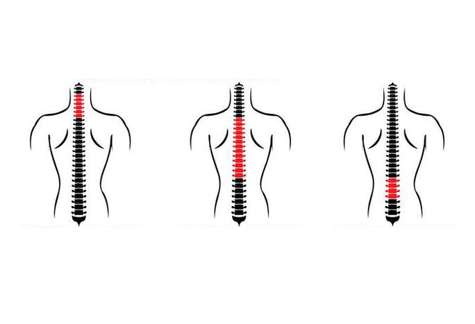 Ako sa prejavuje osteochondróza