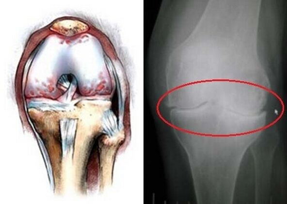 artróza kolenného kĺbu