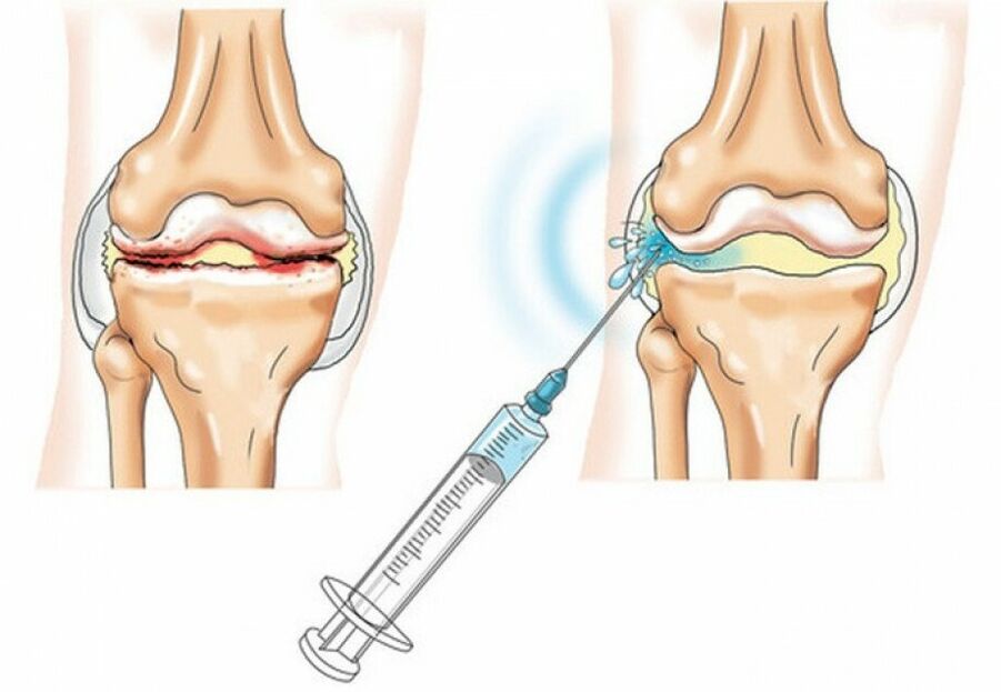 injekcia do kolenného kĺbu s artrózou