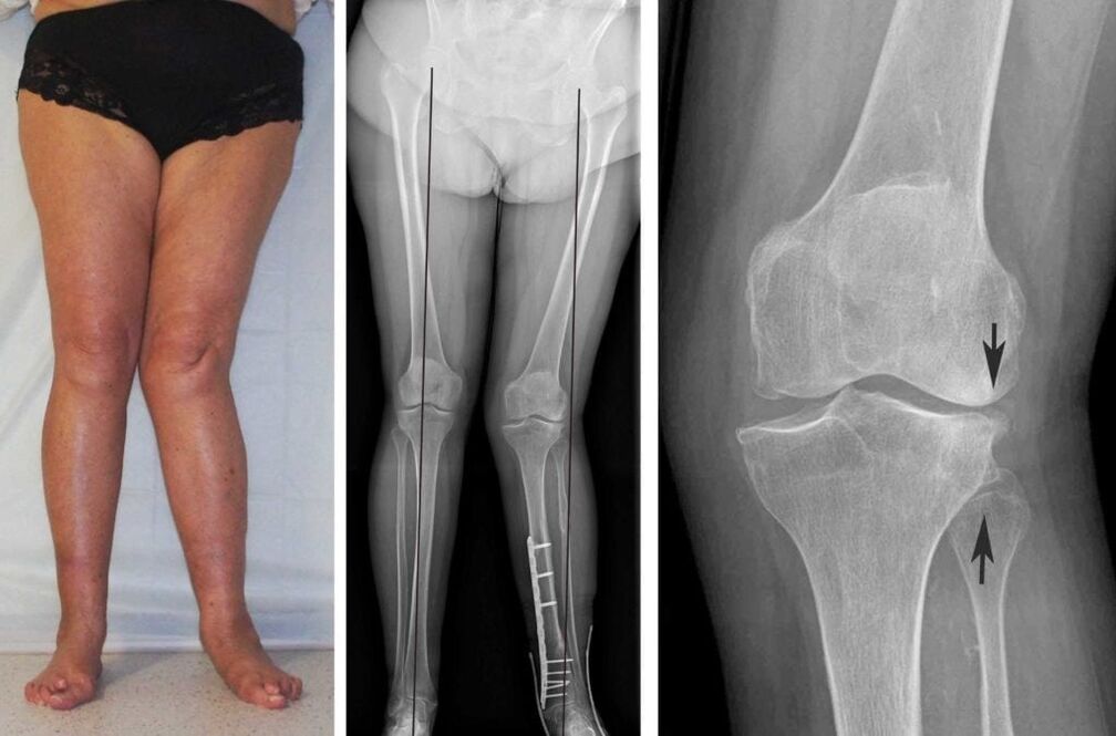 Pokročilá artróza kolenných kĺbov je dobre viditeľná vizuálne aj bez röntgenového žiarenia