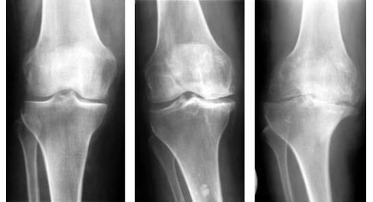 Povinným diagnostickým opatrením pri identifikácii artrózy kolena je röntgen