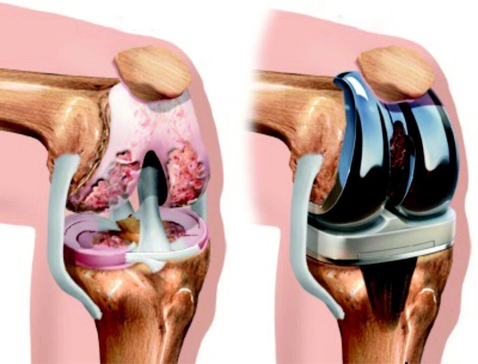Pri totálnom poškodení kolenného kĺbu artrózou je možné ho obnoviť endoprotetikou
